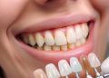 Advantages and Disadvantages of Dental Veneers