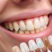 Advantages and Disadvantages of Dental Veneers
